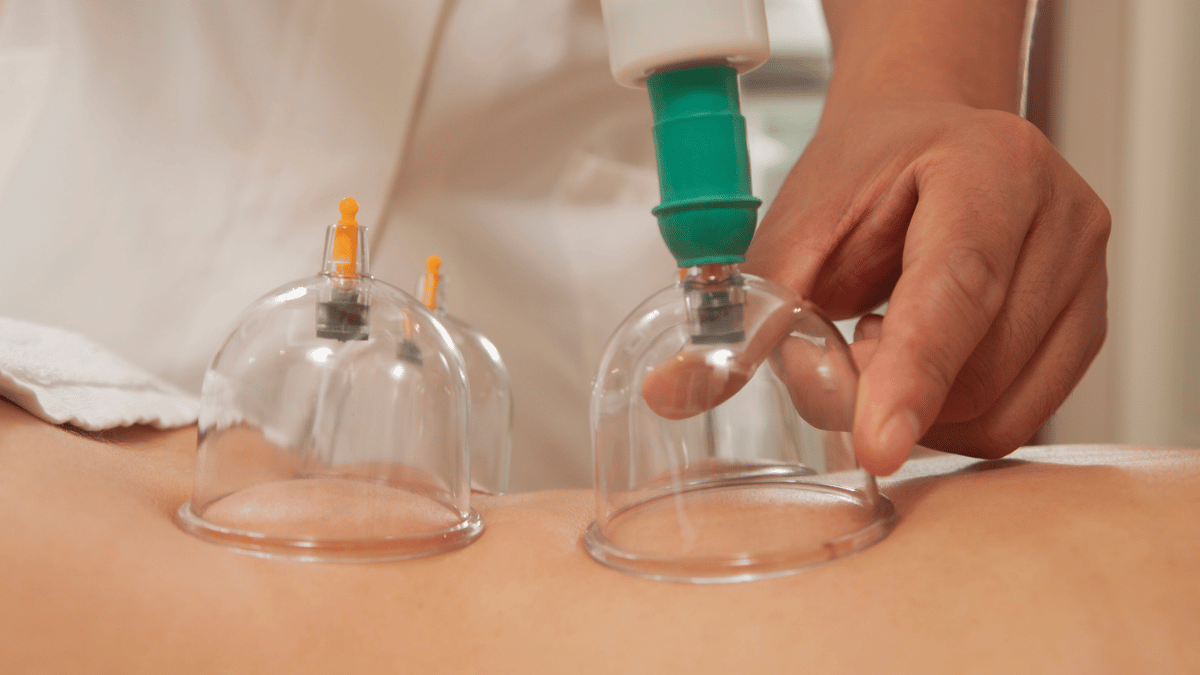 CuppingTherapy.png